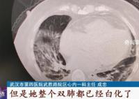 白肺是否會對肺部造成不可逆?zhèn)?這些人做個CT很有必要