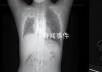 男孩咳嗽發熱在家硬扛成白肺 目前的癥狀已經明顯好轉
