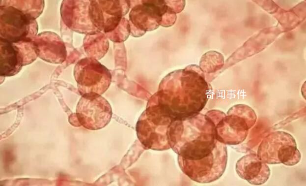 致命真菌在美國蔓延 近一半感染者90天內(nèi)死亡