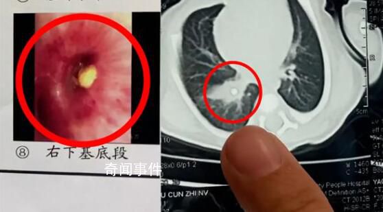 家長信偏方致3天大寶寶氣管堵塞 目前已經轉危為安