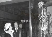 揭秘巨人家族未解之謎 基因突變導致出現巨人癥