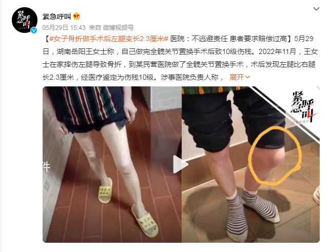 女子骨折做手術后左腿變長2.3厘米 經醫(yī)療鑒定為傷殘10級