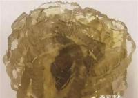 臺(tái)州女子身體里取出了“花” 長(zhǎng)得像玫瑰一樣的結(jié)石你見(jiàn)過(guò)嗎?