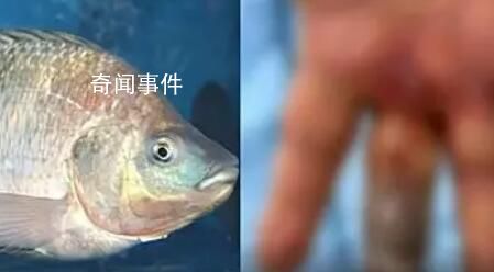 男子被魚刺刺傷致手指壞死被截除 引發了廣泛關注