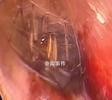 蜘蛛在男子睡夢時鉆入耳道結網(wǎng) 網(wǎng)友：看著就疼