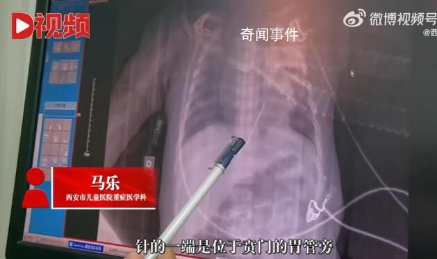 女嬰心臟扎進一根4厘米繡花針 患兒目前在PICU進行康復治療