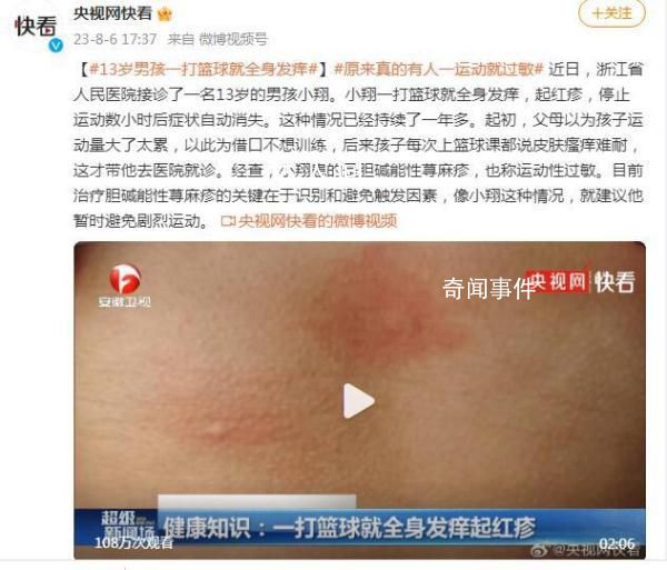 13歲男孩一打籃球就全身發(fā)癢 這種情況已經(jīng)持續(xù)了一年多