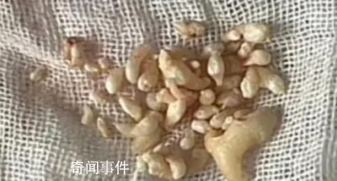 拔掉57顆牙是什么體驗 牙瘤是什么病嚴重嗎
