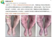 一英國人長期感染新冠導(dǎo)致腿變藍 坐下后2分鐘就恢復(fù)了