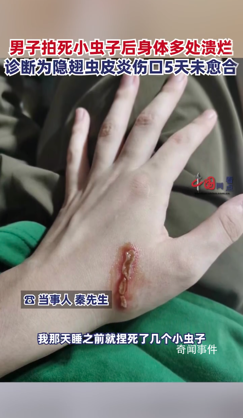 男子拍死隱翅蟲(chóng)多處潰爛5天未愈 目前傷口仍未愈合