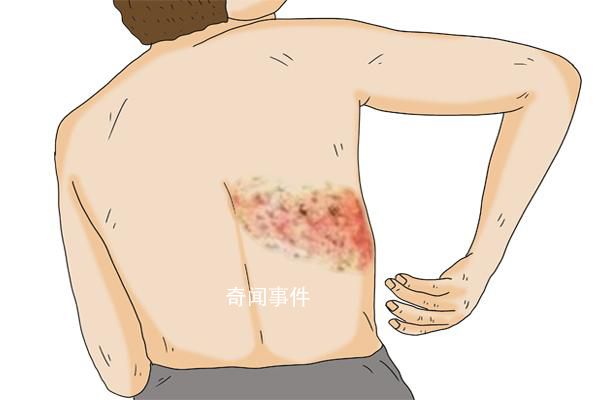 民間流傳纏腰龍纏一圈致命是謠言 帶狀皰疹的癥狀表現(xiàn)及治療方法
