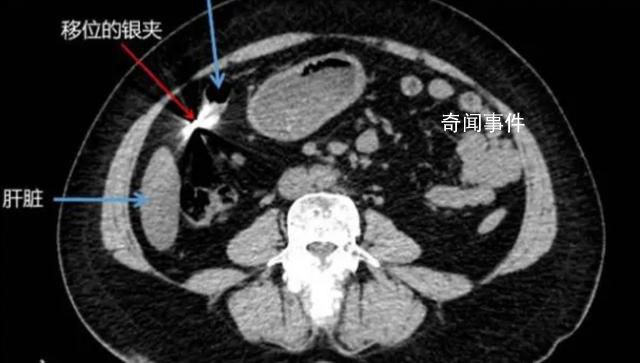 女子車禍后就醫體內發現金屬異物