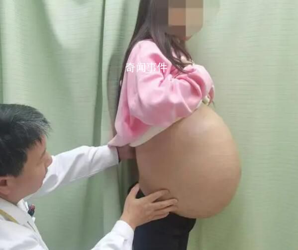 女子腹內長出重46斤巨大脂肪肉瘤 腹部已高高隆起