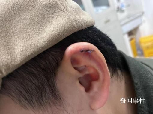 小伙理發(fā)時(shí)耳朵被剪縫六針 雙方?jīng)Q定等拆線(xiàn)后據(jù)傷情再協(xié)商